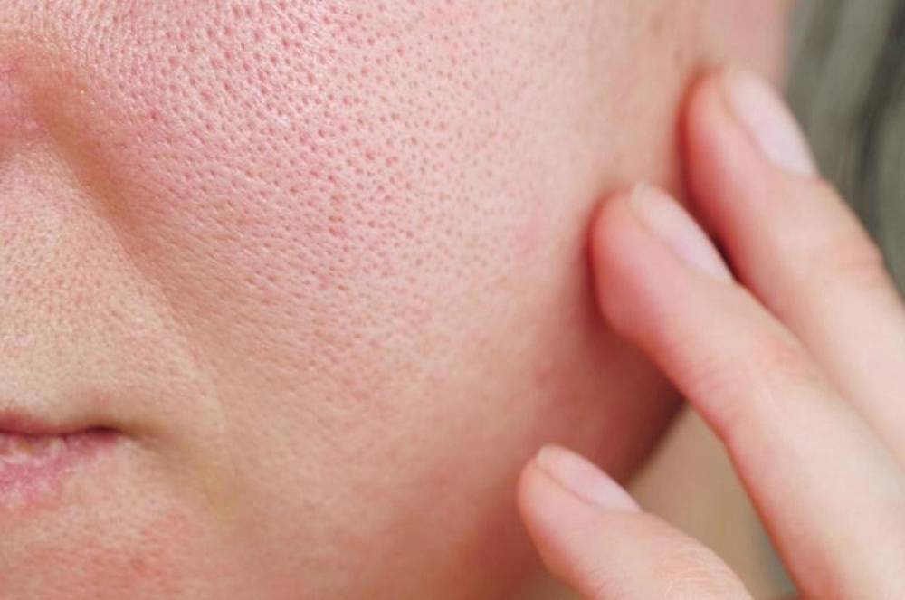 آشنایی با روش های درمان منافذ باز پوست